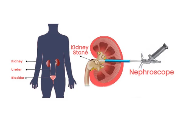 Ummeed Urology and Gynecology