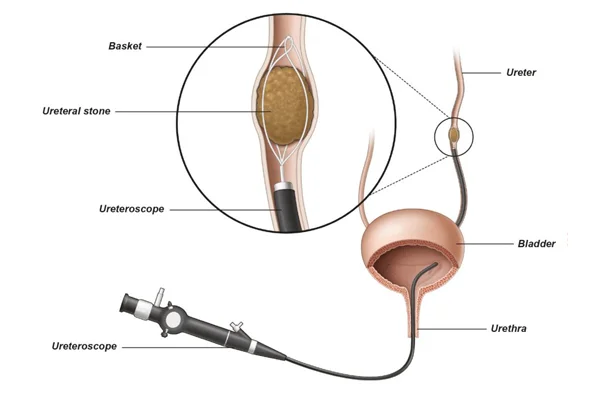 Ummeed Urology and Gynaecology