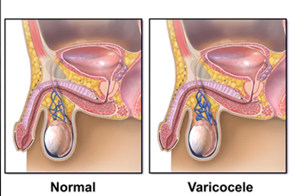 varicocele
