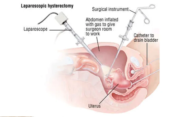 Laparoscopic Hysterectomy