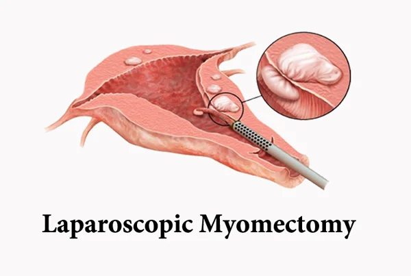 Myomectomy