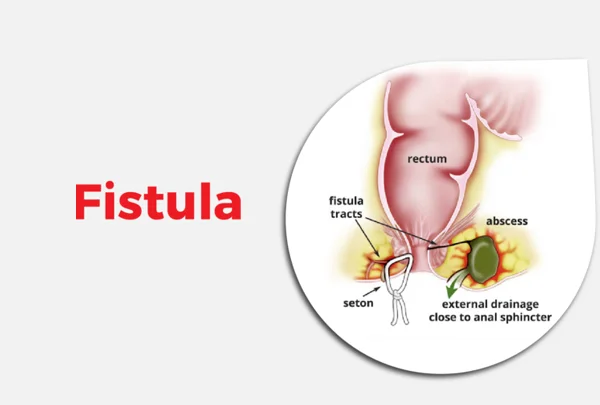 Fistula